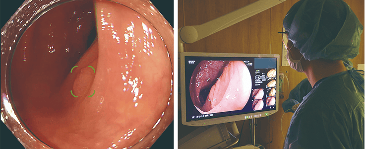 大腸内視鏡検査におけるポリープ検出AI