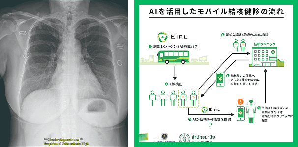 胸部X線画像における結核検出AI