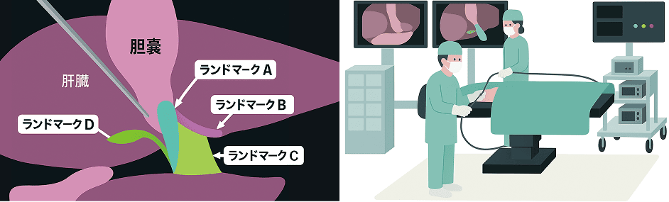 腹腔鏡下胆嚢摘出術向け手術支援AI